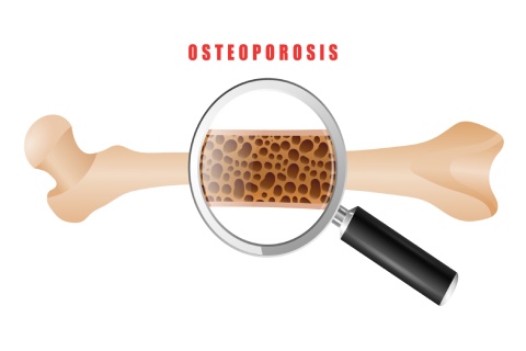 What Is Osteoporosis and What Can You Do?